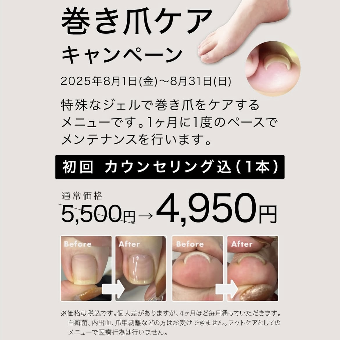 【本館4F/ネイルクイック オアシス】～巻き爪ケアキャンペーン～
